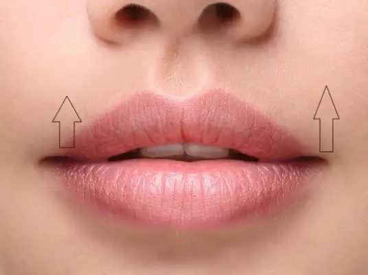 Lip lift surgery in Iran