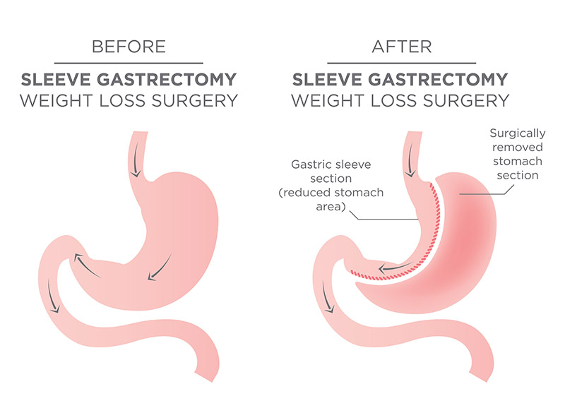 sleeve gastrectomy in Iran
