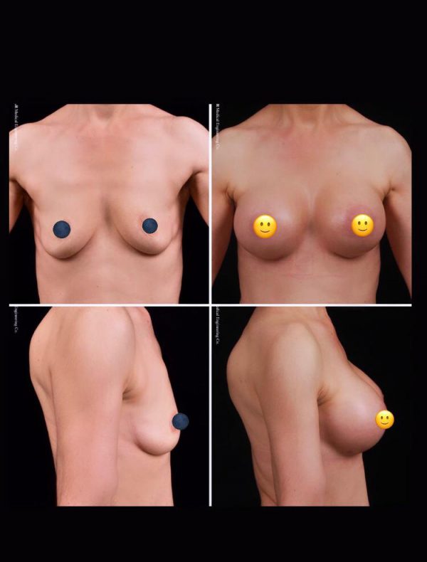 Breast Implants by Dr Amir Daryani in Tehran
