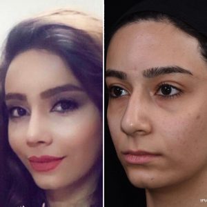 Nose surgery in iran -Dr Amir Daryani