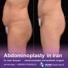 Abdominoplasty in iran Dr Amir Daryani