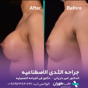 Breast Implants by Dr Amir Daryani in Tehran