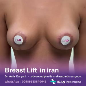 dr daryani-breastlift-in Iran