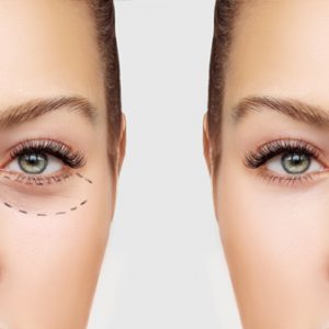 Cosmetic eyelid surgery in Iran