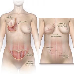 breast reconstruction in Iran Dr Amir Daryani