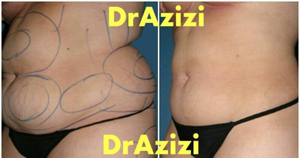 Vaser Liposuction and Abdomen in Iran