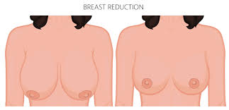 Breast reduction in Iran