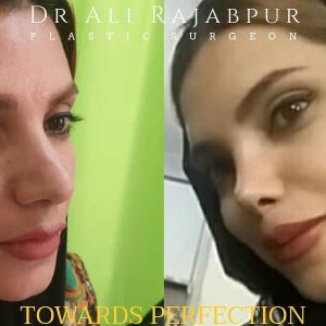 rhinoplasty in iran - Dr. Ahmad Ali Rajabpur