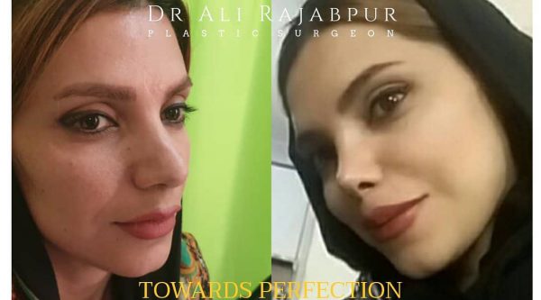 rhinoplasty in iran - Dr. Ahmad Ali Rajabpur