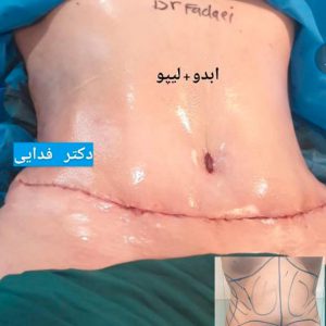 abdominoplasty in Iran