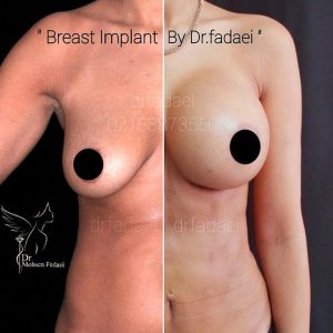 Breast Implants by Dr. Mohsen Fadaei