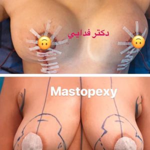Breast lift by Dr. Mohsen Fadaei