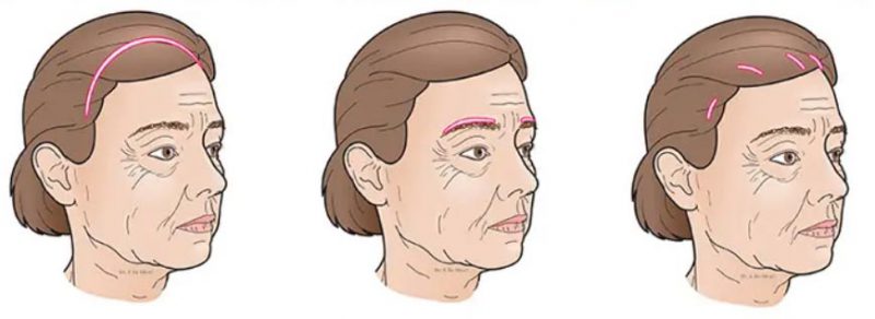 endoscopic eyebrow lift and forehead lift