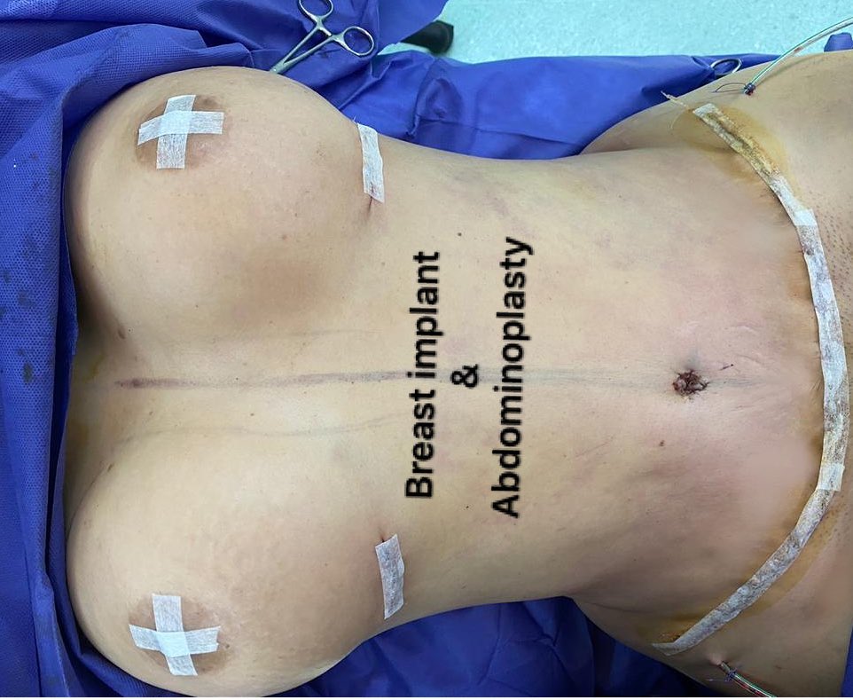 Sample video of Dr. Azizi's abdominoplasty