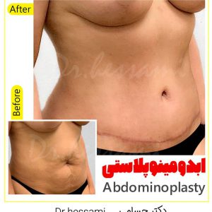 Plastic surgery abdomen in Iran