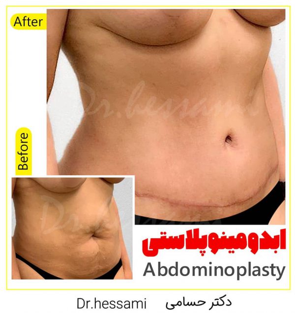 Plastic surgery abdomen in Iran