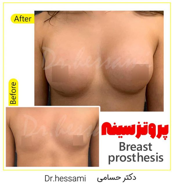 Breast Implant in Iran