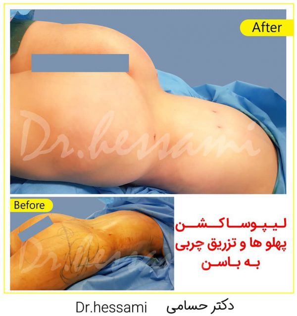 fat injection in the buttocks in Iran