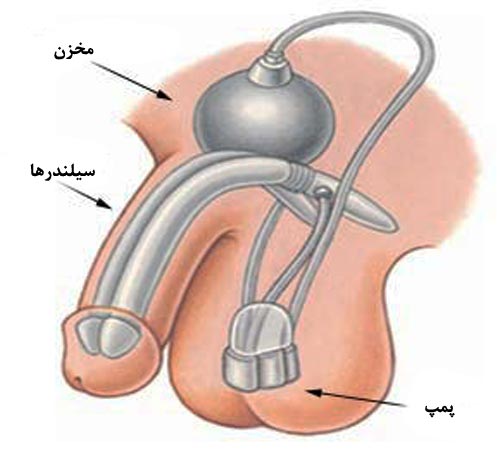 Penile Implant Surgery in Iran