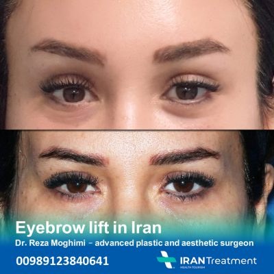 Forehead lift in Iran