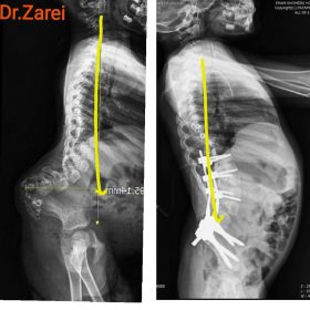 Correction of severe and progressive kyphosis