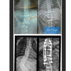 Congenital scoliosis surgery in Iran