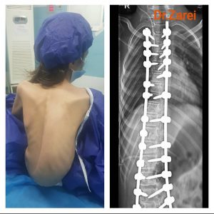 Orthopedist specializing in spinal surgery in Iran