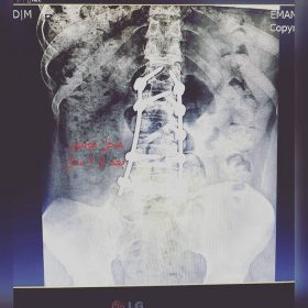 Primary malignant tumors of the spine