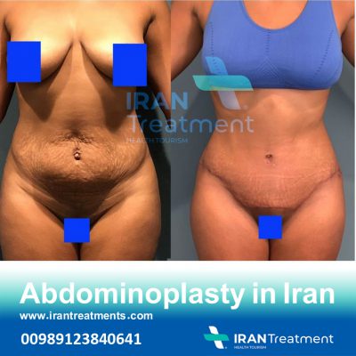 Abdominoplasty In Iran
