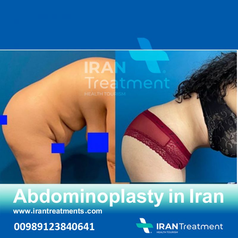 Tummy Tuck in Iran ✔️, 360-Abdominoplasty