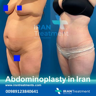 Abdominoplasty In Iran