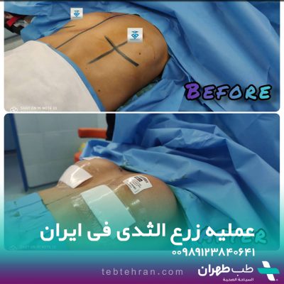 Before and after photos of breast prosthesis surgery