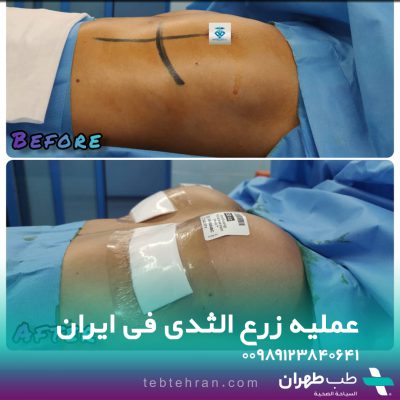Before and after photos of breast prosthesis surgery