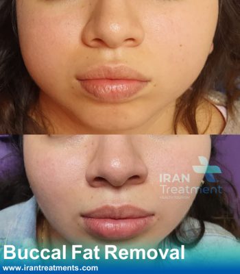 Buccal Fat Removal in Iran