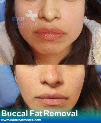 Buccal Fat Removal in Iran