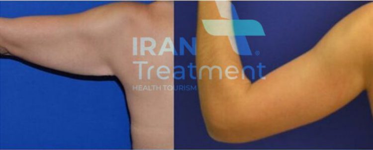 arm lift in Iran