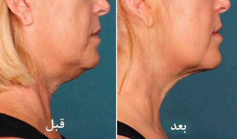 lipomatic double chin in Iran