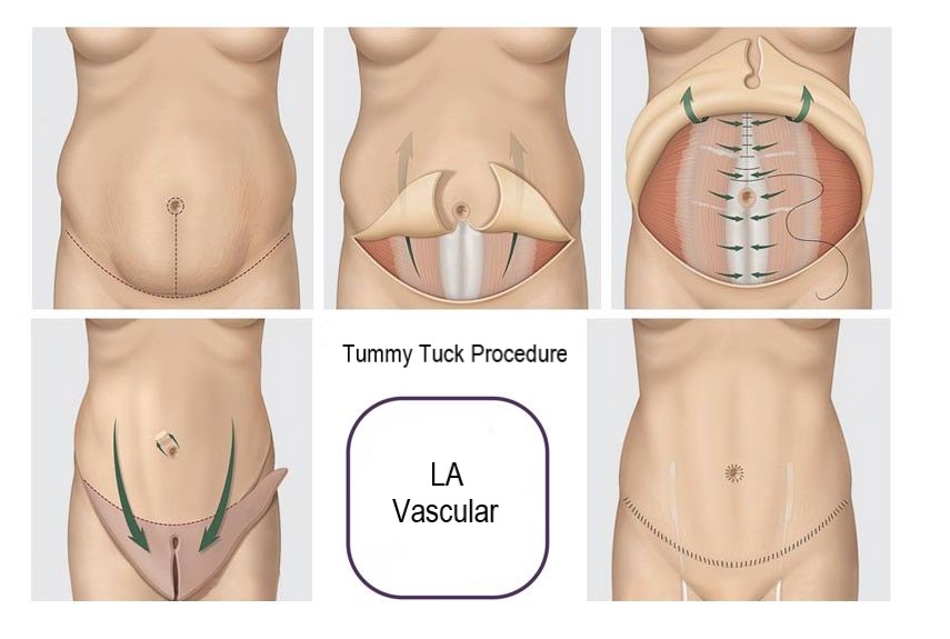 🥇 Tummy Tuck / Abdominoplasty