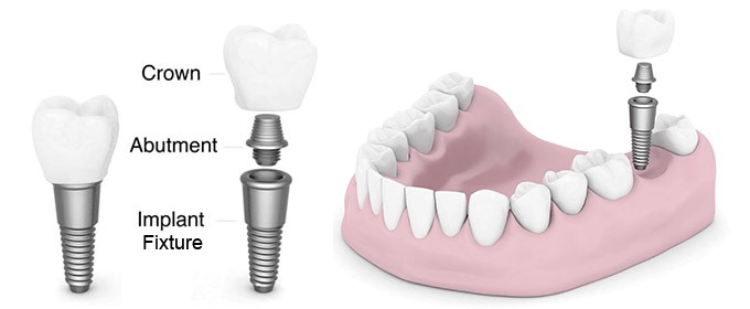 Dental implants in Iran