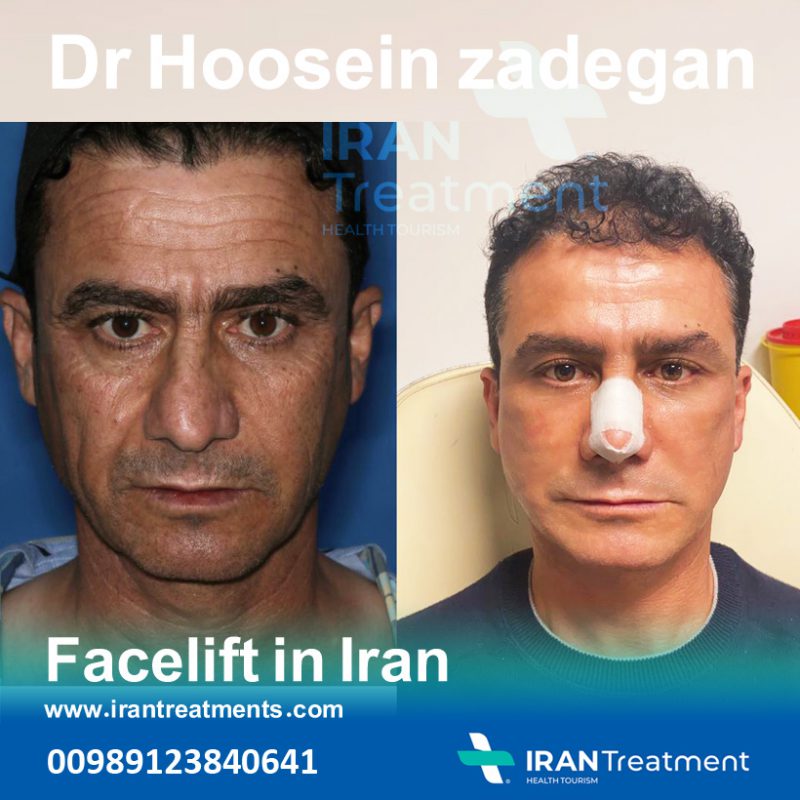 facelift in iran