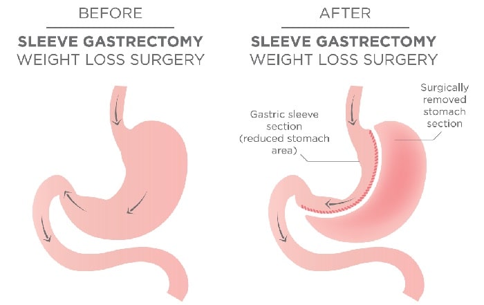 Gastric sleeve surgery in Iran