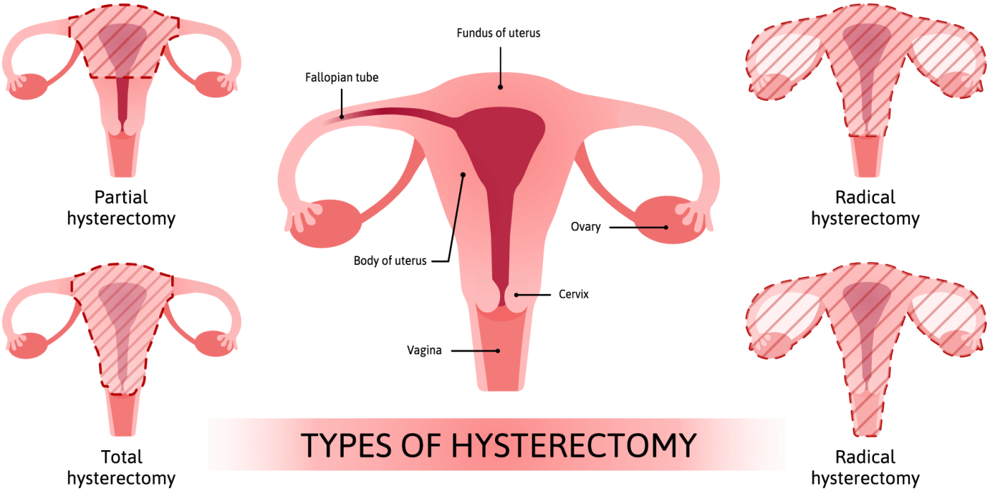 hysterectomy in Iran