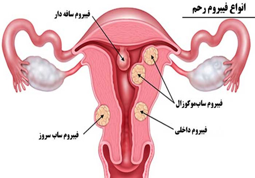 uterine fibroids in Iran