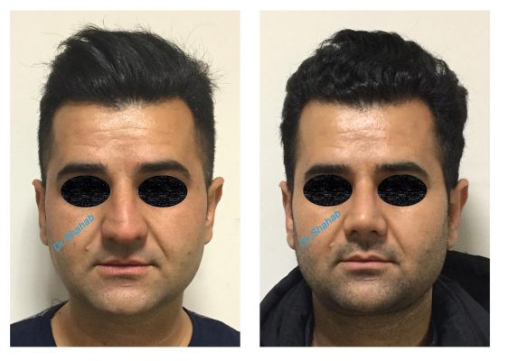 Men's Rhinoplasty before - after photo in Iran