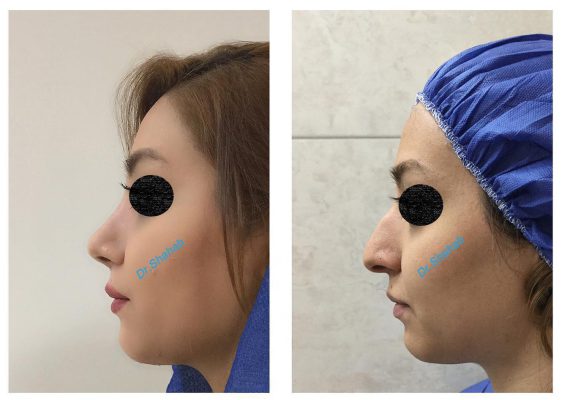 Rhinoplasty before - after photo in Iran