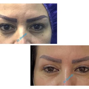 Blepharoplasty before - after photo in Iran