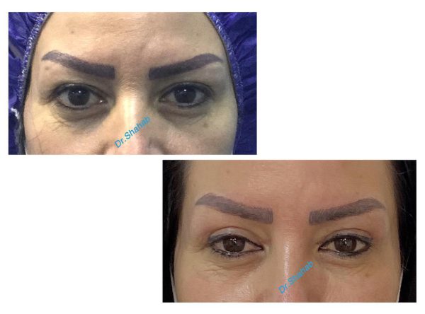 Blepharoplasty before - after photo in Iran