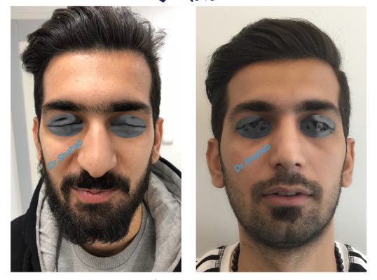 Men's Rhinoplasty before - after photo in Iran
