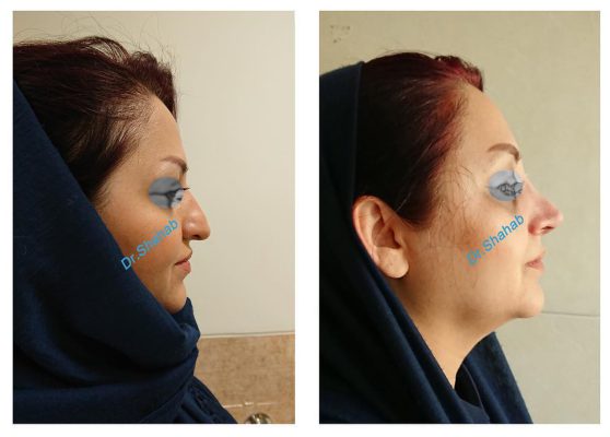Rhinoplasty before - after photo in Iran