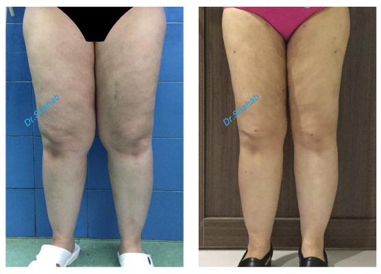 Leg lipo before - after photo in Iran